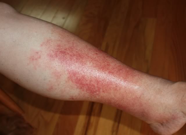 Cellulitis Skin Infection | Universal Health Care