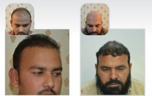 Fue hair transplant clinic Lahore Pakistan