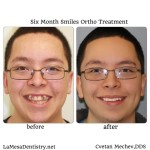 la mesa dentist six month smiles