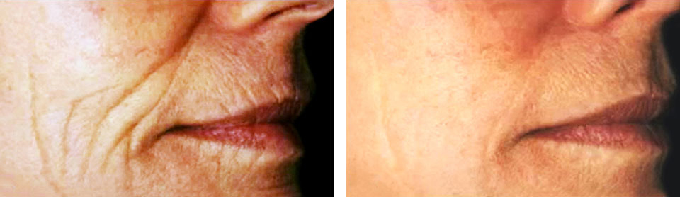 before & after using Dermastrips