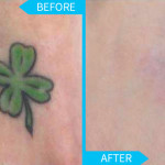 tattoo removal at Surgical Dermatology