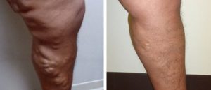 varicose veins - before and after at Clínica de Terapia Vascular